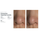 KIWI™ Blackhead Remover Pore Vacuum KIWI™ (1259139_EA) 1/EA