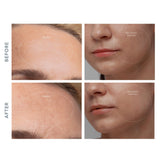 KIWI™ derma Diamond Microdermabrasion Pore Vacuum KIWI™ derma (1244547_EA) 1/EA