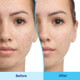 Differin® Acne Treatment 45 Gram Gel (1230047_EA) 1/EA