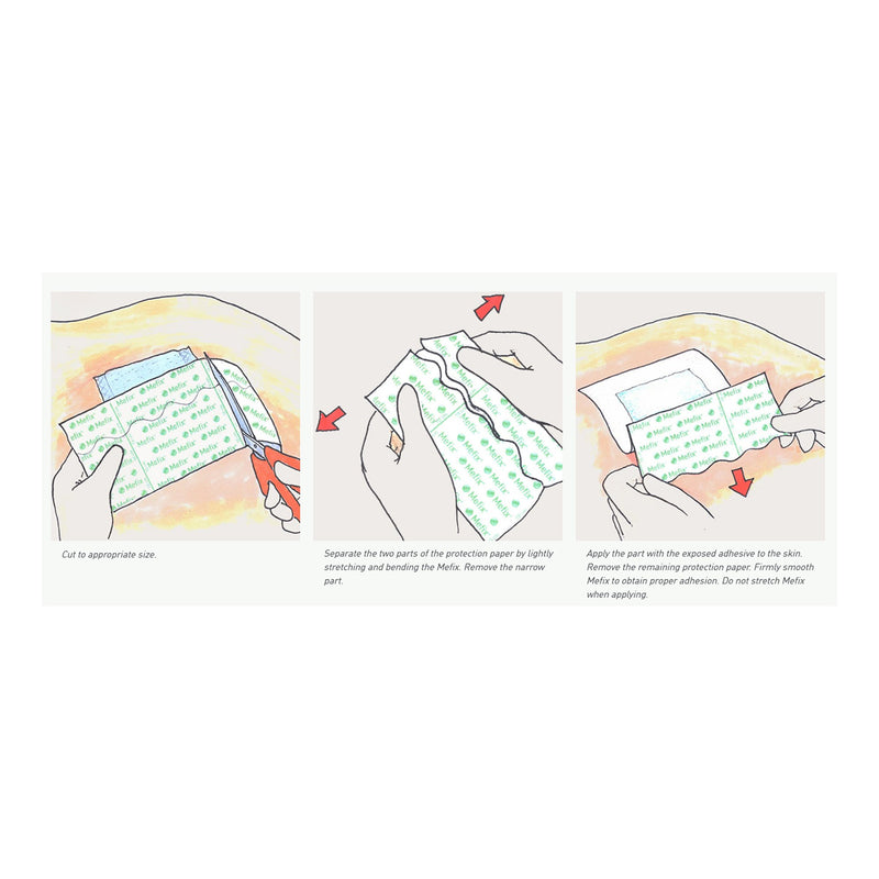 Mefix® Perforated Dressing Retention Tape with Liner White 4 Inch X 11 Yard Nonwoven Spunlace Polyester NonSterile (684056_EA) 1/EA