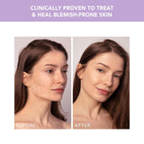 ESPADA™ 2 plus Acne Treatment ESPADA™ 2 plus (1259141_EA) 1/EA