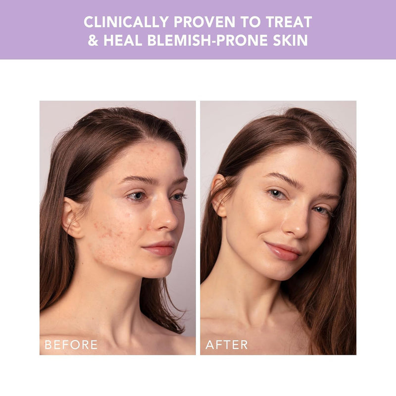 ESPADA™ 2 plus Acne Treatment ESPADA™ 2 plus (1259141_EA) 1/EA