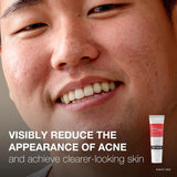 Neutrogena® Rapid Clear Acne Treatment 1 oz. Gel (1250875_EA) 1/EA