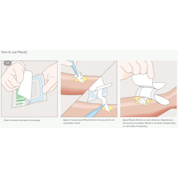Mesalt® Sodium Chloride Impregnated Dressing Square 4 X 4 Inch / 2 X 2 Inch Folded Sterile (400464_BX) 30/BX