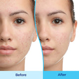 Differin® Gel Acne Treatment 15 Gram Gel (1135869_EA) 1/EA
