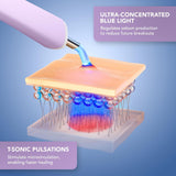 ESPADA™ 2 plus Acne Treatment ESPADA™ 2 plus (1259141_EA) 1/EA